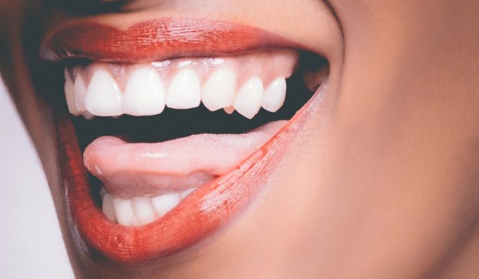 Porcelain Veneers