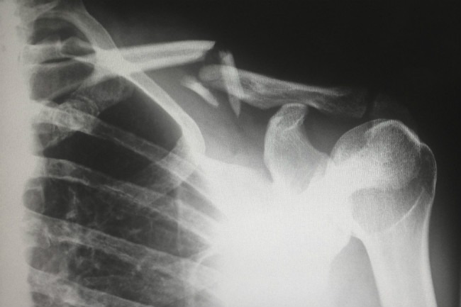 It takes time to recover from an injury.